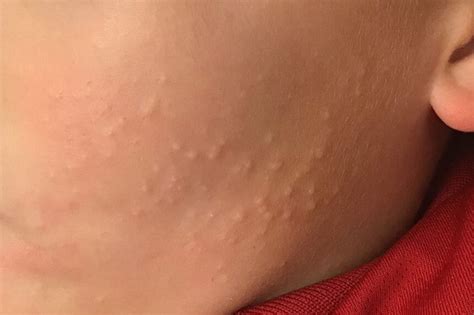 clinical challenge red bumpy rash   child mpr