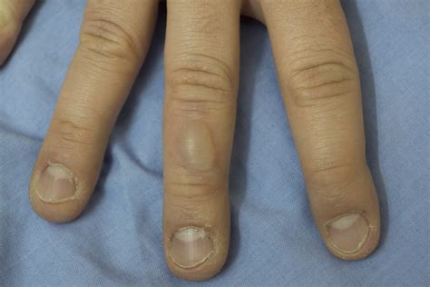 Should A Mucous Cyst On Finger Be Removed - Infoupdate.org