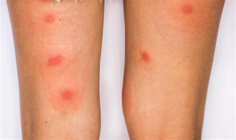O Que Pode Ser Manchas Vermelhas Nas Pernas - Manchas Vermelhas nas Pernas: 6 Causas e Remédios Caseiros