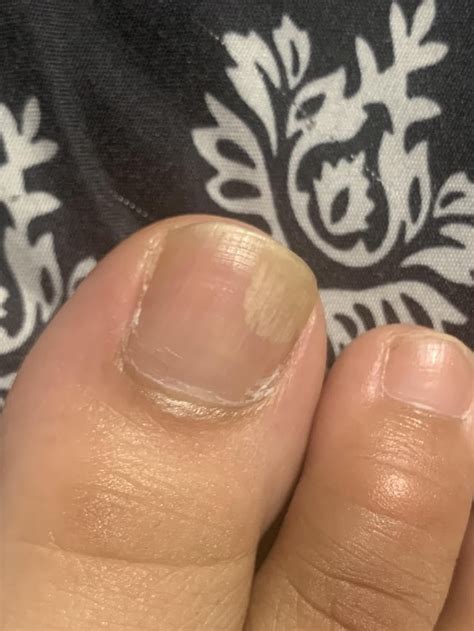 fungal growth    rmedical