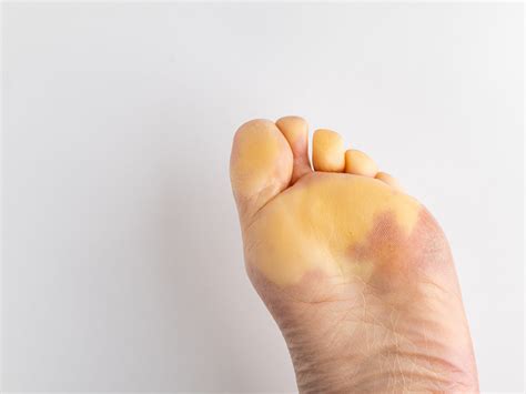 Raynaud’s Disease | The Chelsea Clinic Chiropodists Podiatrists