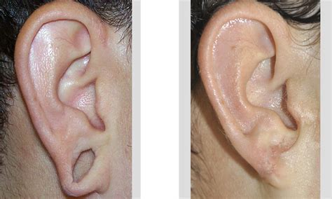 Reconstruction of the Gauged Earlobe Dr Barry Eppley Indianapolis right ...