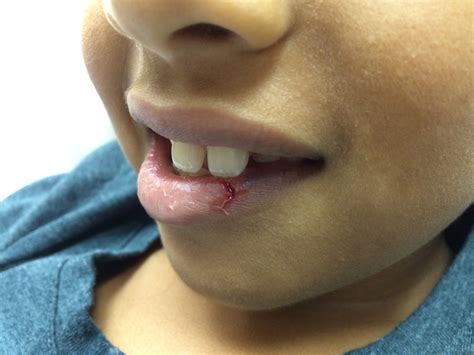why isn't my lip cut healing 5