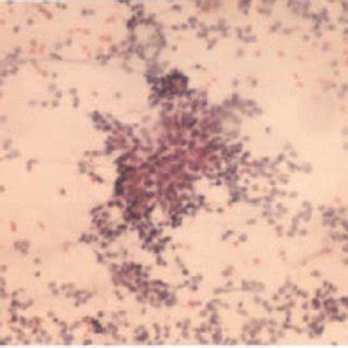 Microphotograph of complex hyperplasia without atypia showing irregular ... 