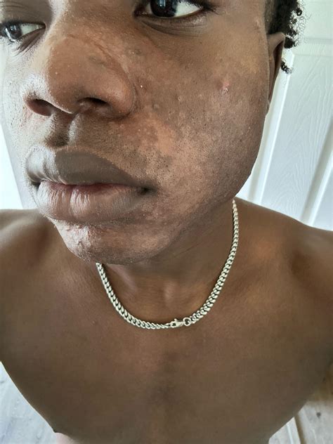 Tinea Versicolor On Face