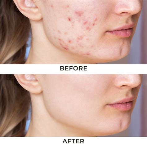 how to shrink a cystic pimple overnight 11