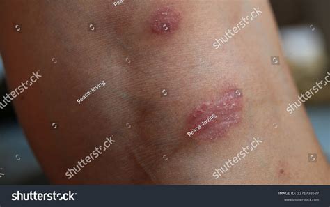 Psoriasis Skin Disease Causes Rash Itchy Stock Photo 2271738527 ...
