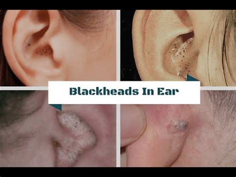 How to remove blackhead in ears-Health Ears - YouTube