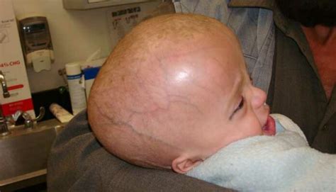 20 Best Government and Private Hospitals for Hydrocephalus or Jalshirsh ...