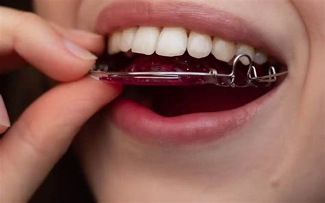 how to fix a snaggle tooth