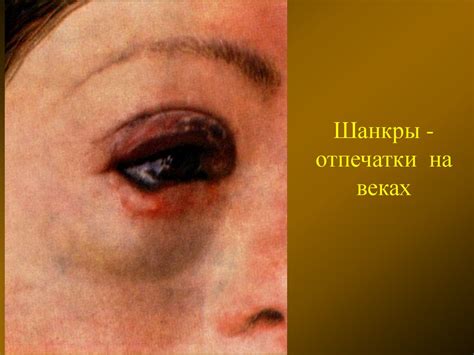 Первичный период сифилиса - презентация онлайн