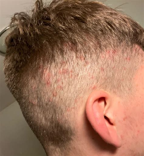 Gram Negative Folliculitis- Klebsiella : r/Folliculitis