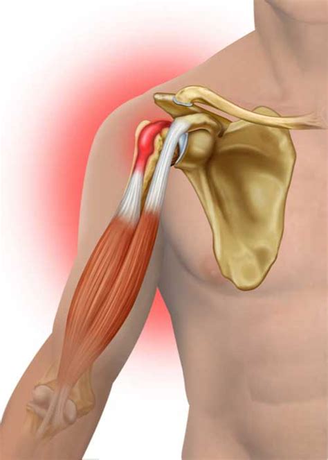 Biceps Tendon Tear | Shoulder Specialist | Van Nuys, Westlake Village ...
