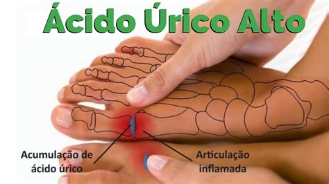O Que É Ácido Úrico Alto - ÁCIDO ÚRICO ALTO. Aprenda a TRATAR EM CASA acabe com as dores e o ...