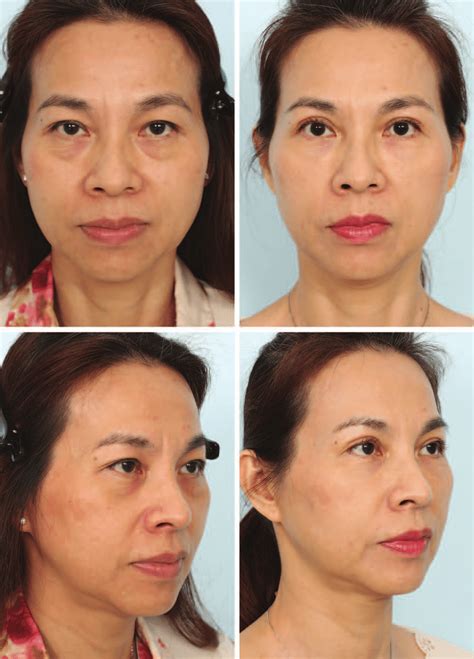 Photographs obtained (left) before surgery and (right) 1 year ...