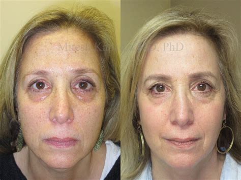 laser skin resurfacing  treatments