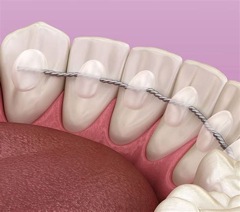 8 Things To Know About Your Permanent Retainer — Orthodontic Arts