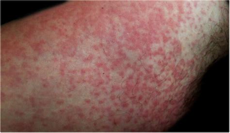 Detail of the rash. Overview of the rash. | Download Scientific Diagram