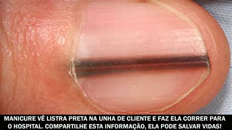 Linhas Escuras Nas Unhas - Por Que As Unhas Têm Manchas Escuras? – UNTZ