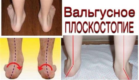 Вальгусное плоскостопие у детей и взрослых: фото и лечение, Комаровский