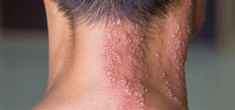 shingles herpes zoster dermatology  skin health dr mendese