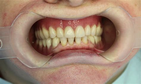 Телескопический протез - Стоматология Набережные Челны - DENTAL FORTE ...