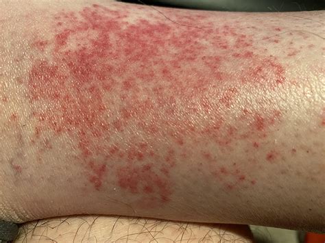 Leg Heat Rash Golfer S Vasculitis at Jarred Moen blog