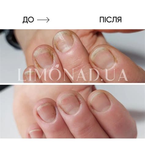 Масло для ногтей и кожи Onistop Nails Of The Day (для лечения ...