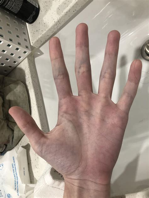 Anyone else with circulation issues? My hands 3 weeks post first shot