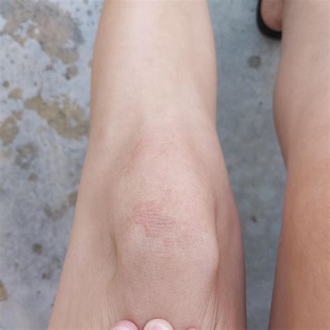 What is this rash on my knee? : r/medical