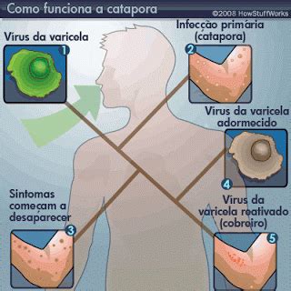 Como E Transmitida A Catapora - Aprenda sobre a Catapora