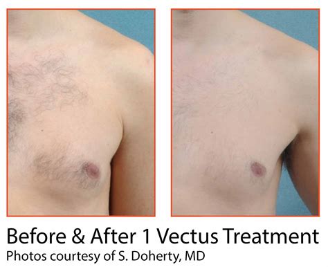 $49/mo Brazilian Laser Hair Removal - Waxoxo Sugaring Waxbar