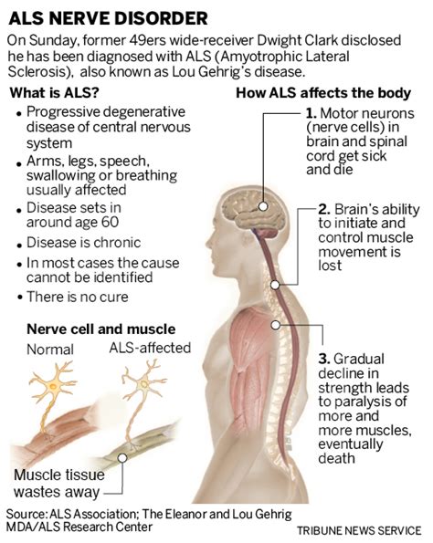 49ers' Dwight Clark tragedy: Can football cause ALS?