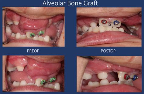 ortho  cleft palate  mary spaulding blog