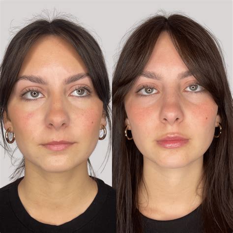 Fillers Before And After | Roots Wellness And Med Spa