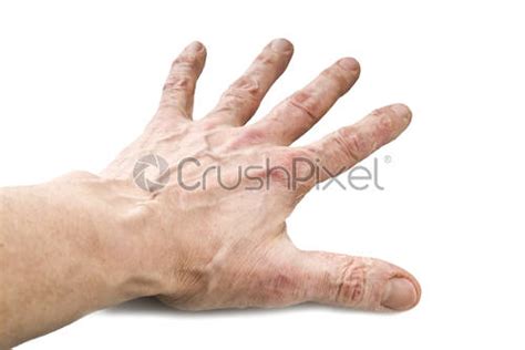 Psoriasis, skin disease on the joints of the body - stock photo 705973 | Crushpixel