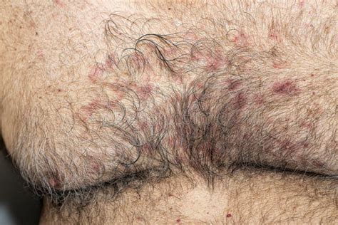close   seborrheic dermatitis   male patient stock photo image