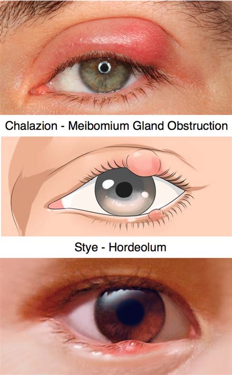 Eyelid Infections - Chalazion and Stye (Hordeolum)