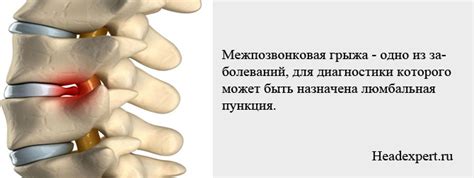 Люмбальна пункція: показання, протипоказання | Бережіть здоров'я!