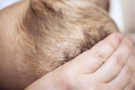 Seborrheic Dermatitis - VitalSkin Dermatology