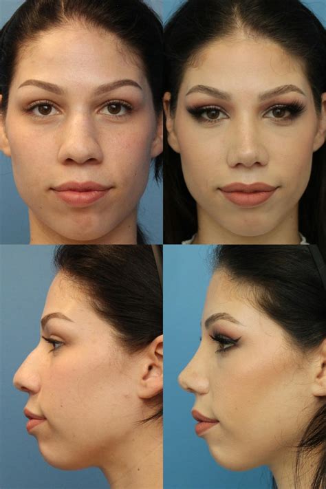 Thick Skin / Ethnic Rhinoplasty Before & After Photos | Ranch & Coast
