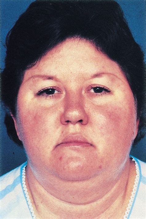 buffalo hump moon face cushing syndrome before and after 6