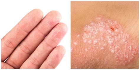 The Difference between Eczema and Psoriasis