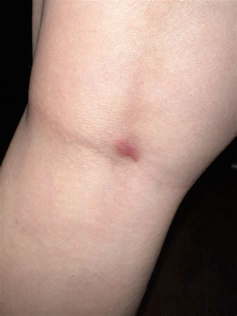 randomly got a red lump behind my knee and it feels like i’ve pulled a