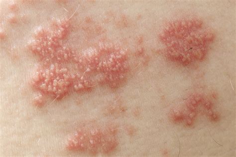 shingles herpes zoster transmission symptoms treatment