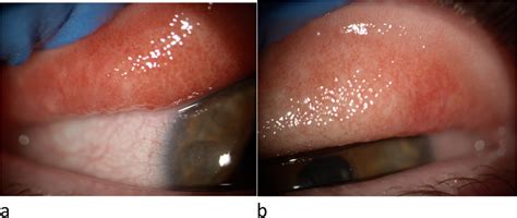 Slit-lamp examination, right (a) and left eye (b) | Download Scientific ...