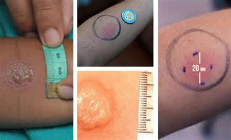 Tb Skin Test Procedure