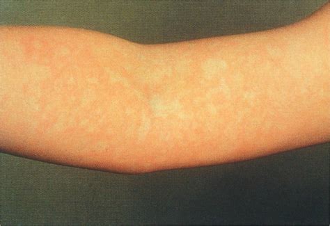 Reticular Rash Fifth Disease