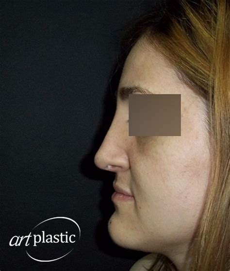 Ринопластика / Фото / Альбом №46 | Клиника Art-Plastic