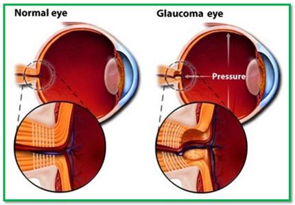 natural treatment  glaucoma ayurvedic medicines herbal remedies